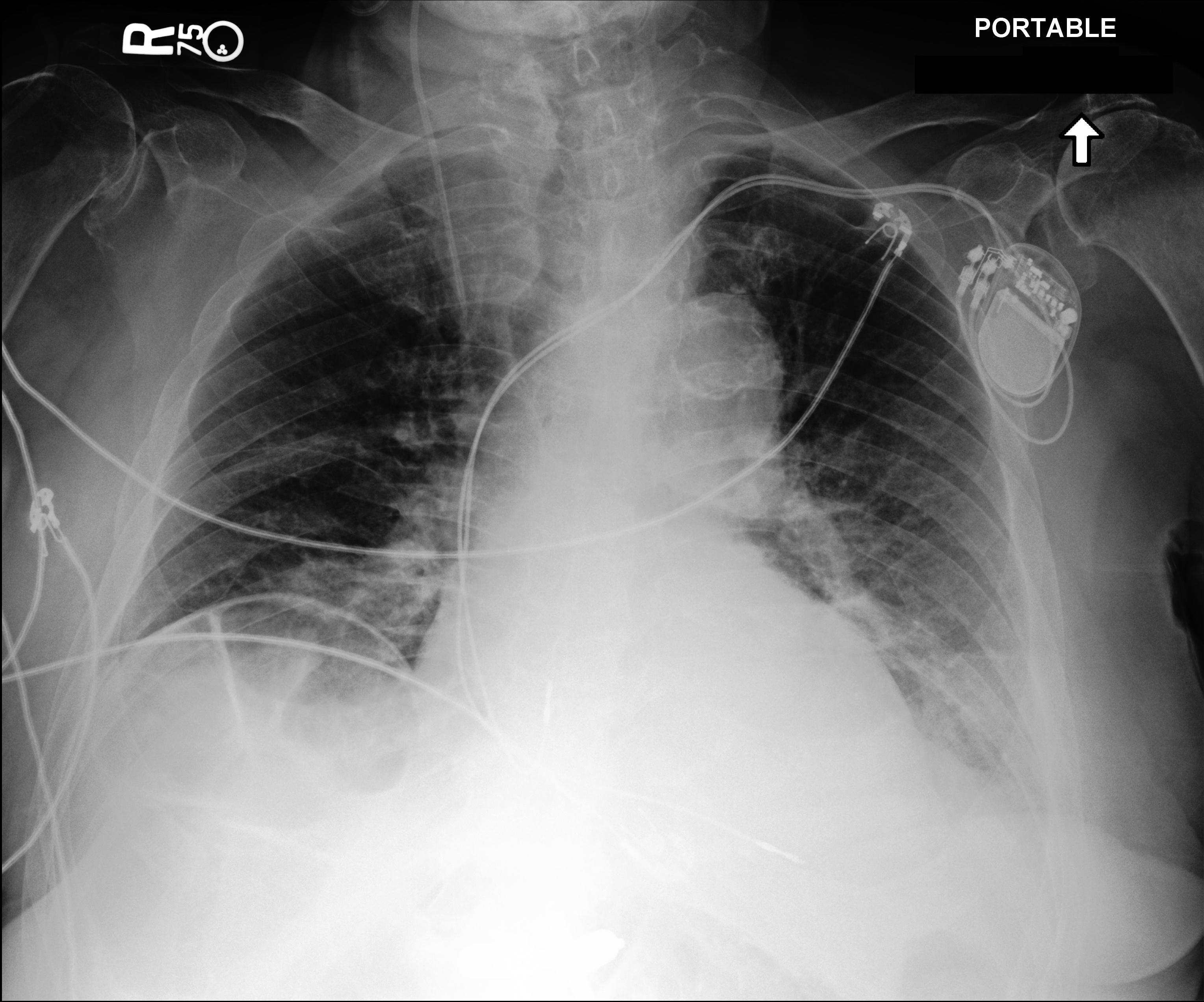 Chest X-Ray