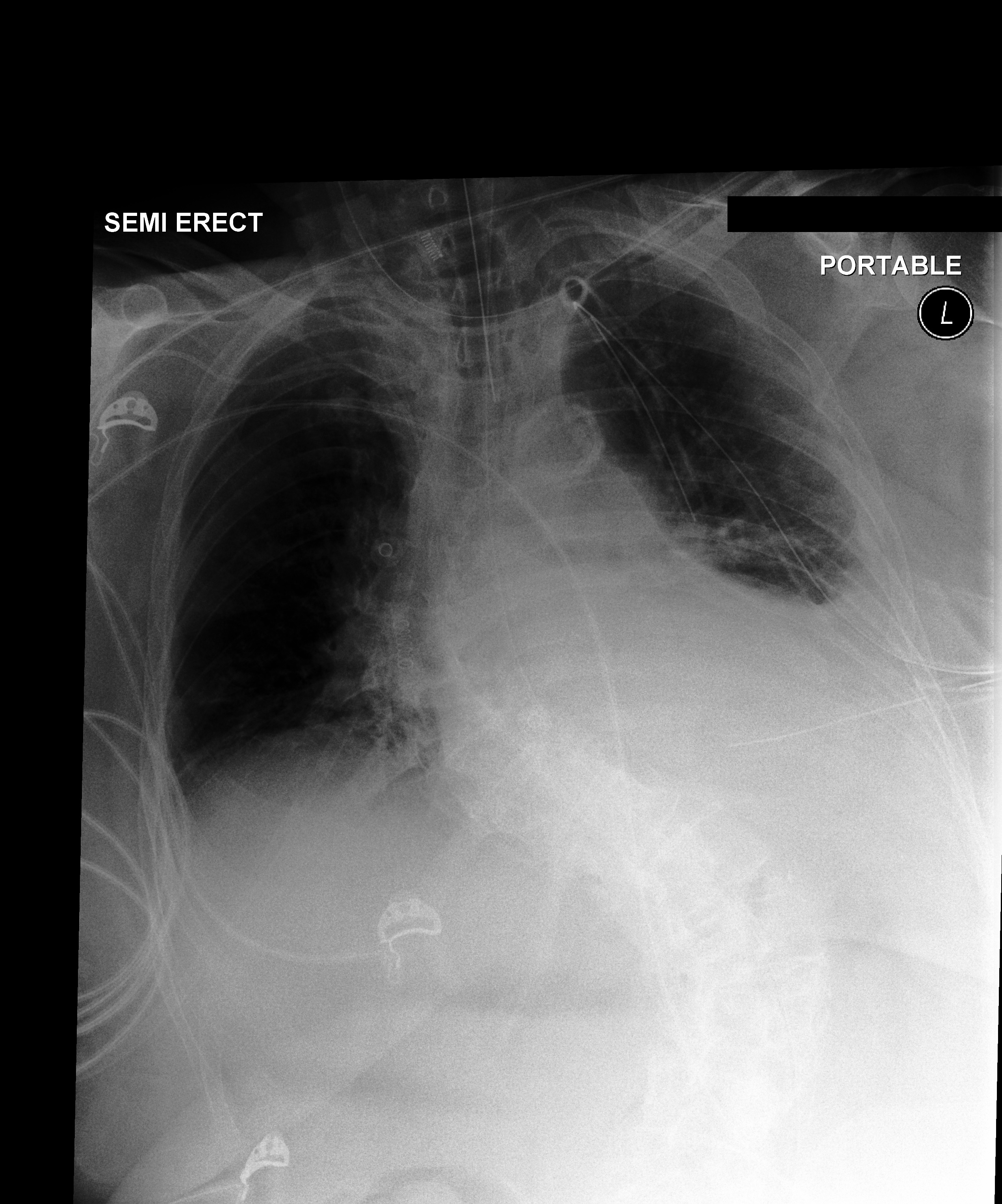 Chest X-Ray