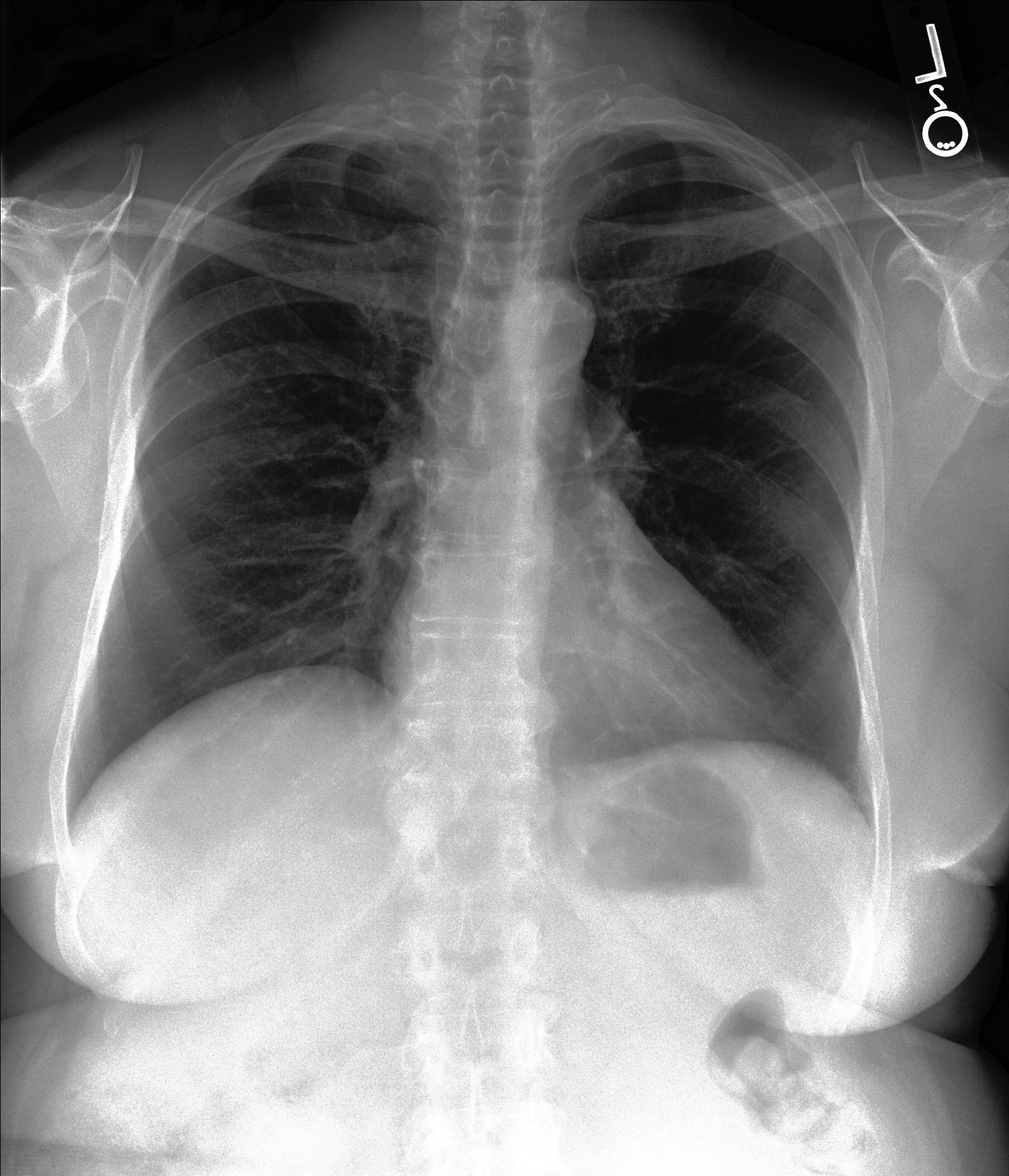 Chest X-Ray