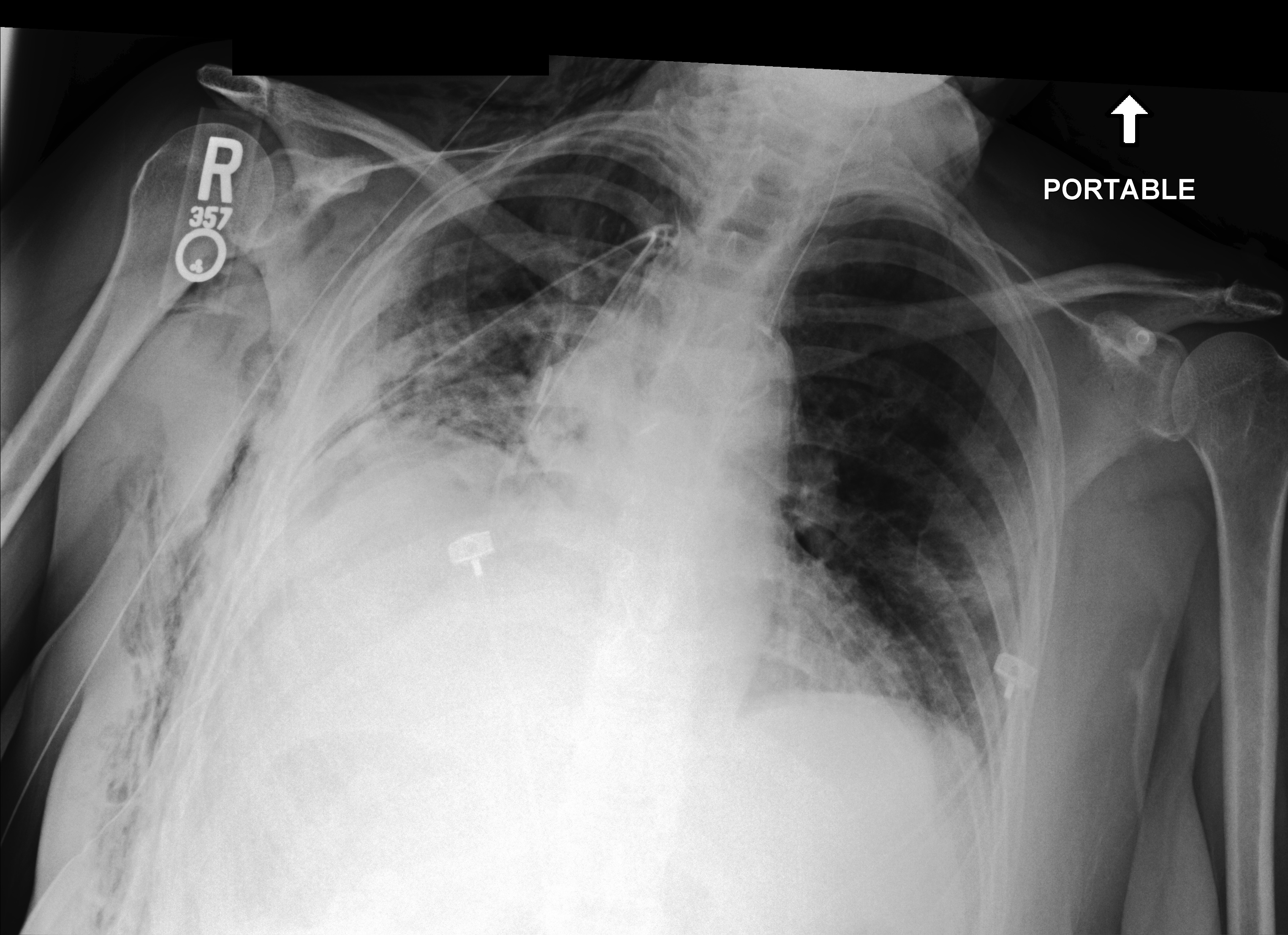 Chest X-Ray