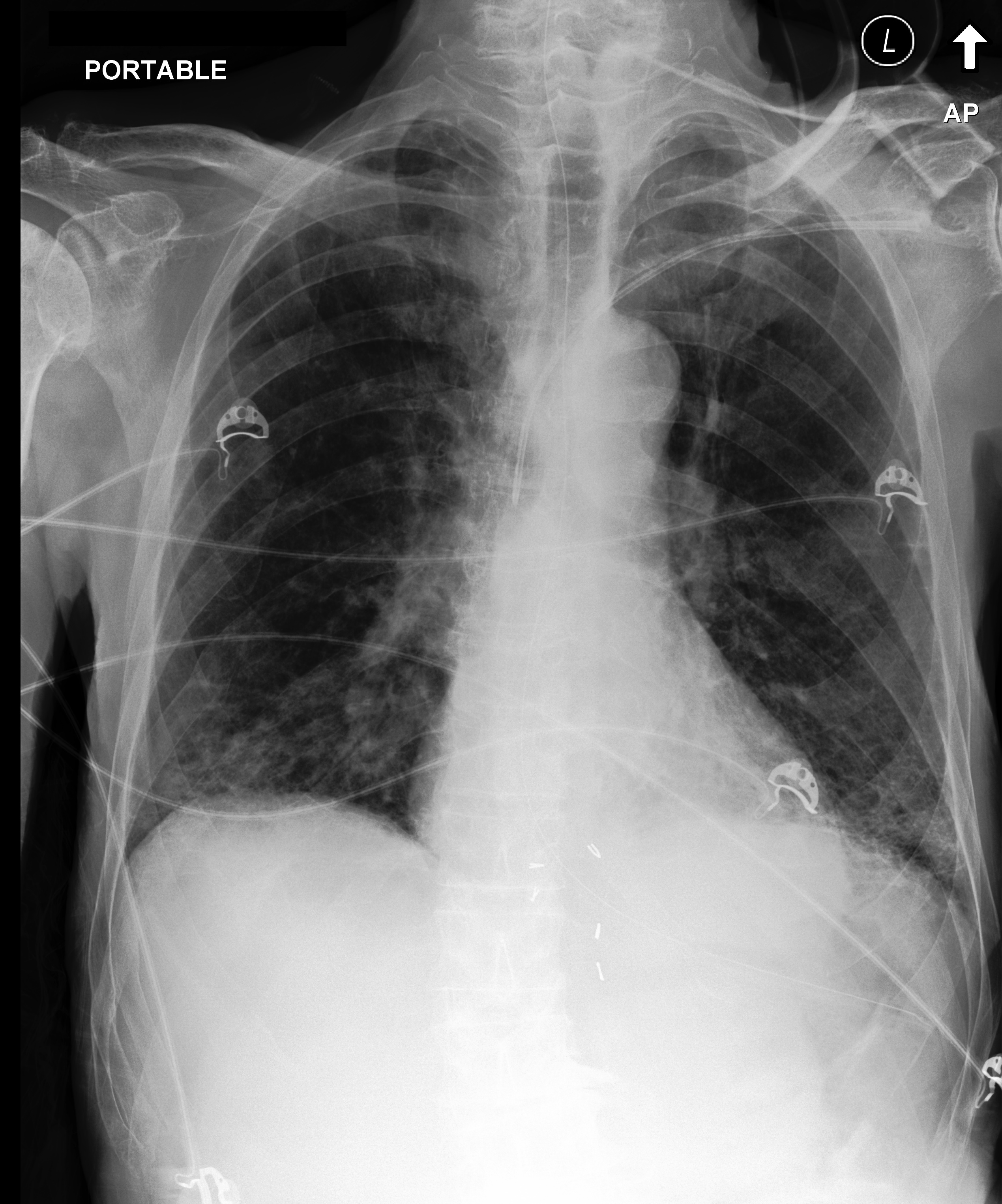 Chest X-Ray