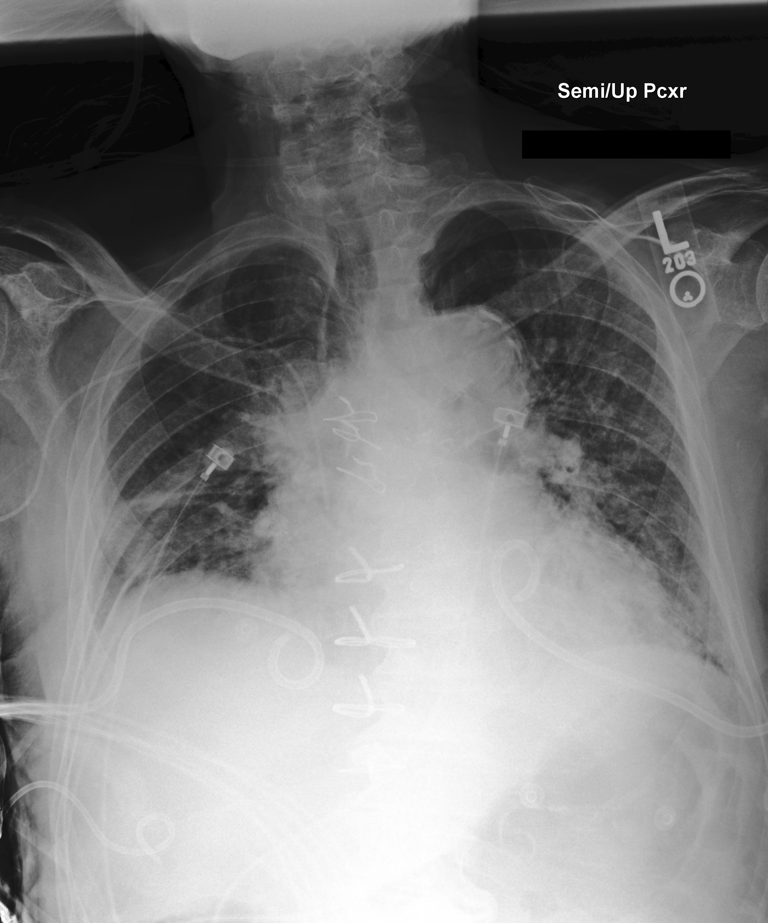 Chest X-Ray