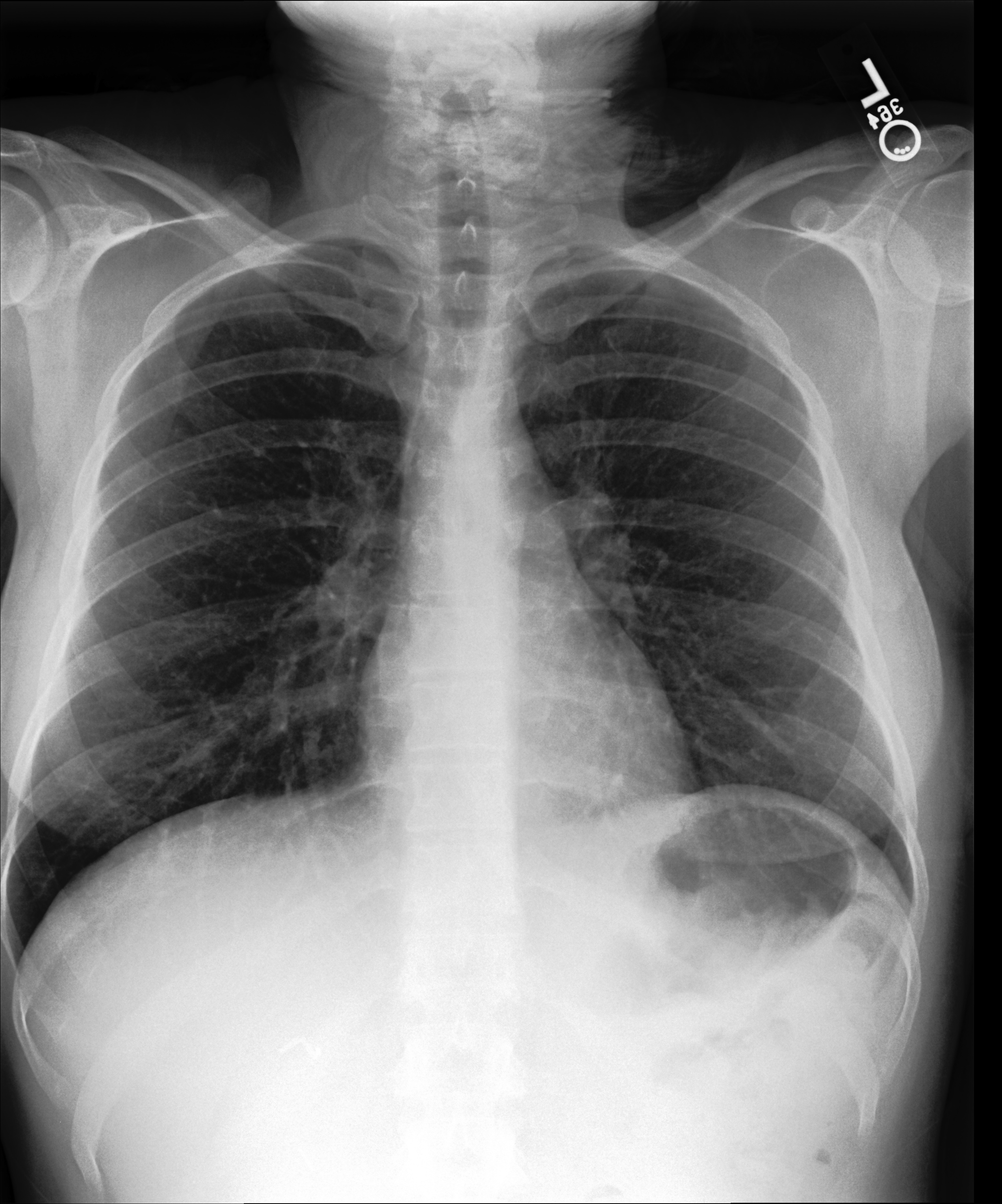 Chest X-Ray