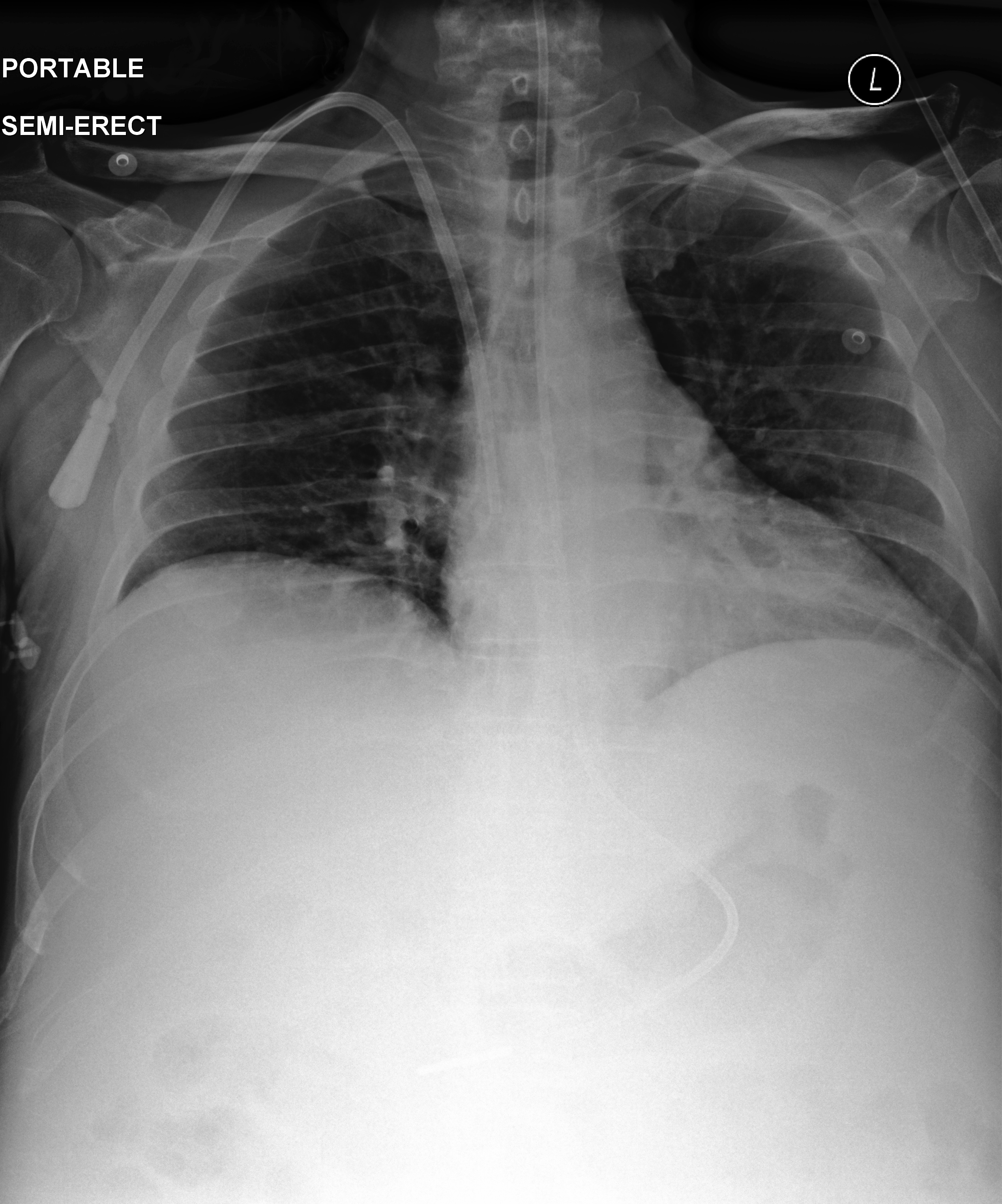 Chest X-Ray